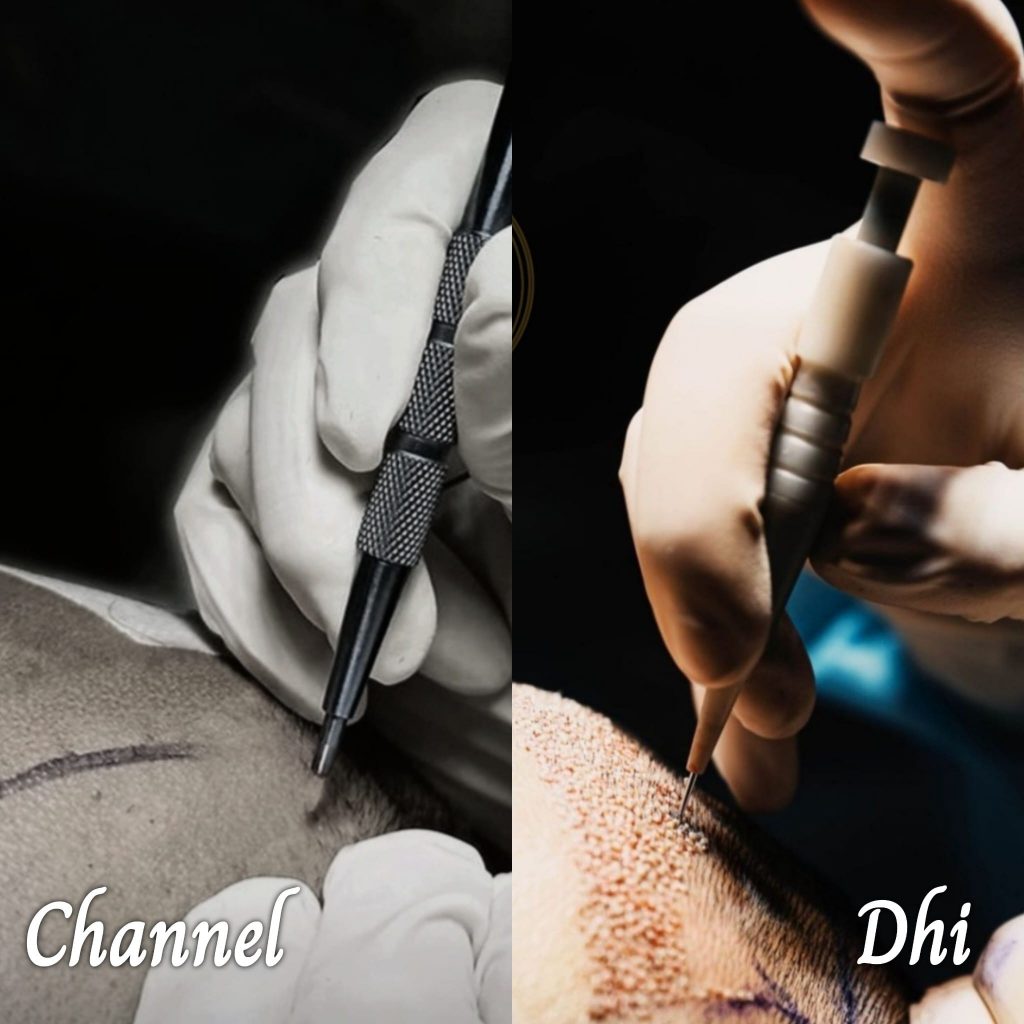 DHI or FUE Technique Hair Implant