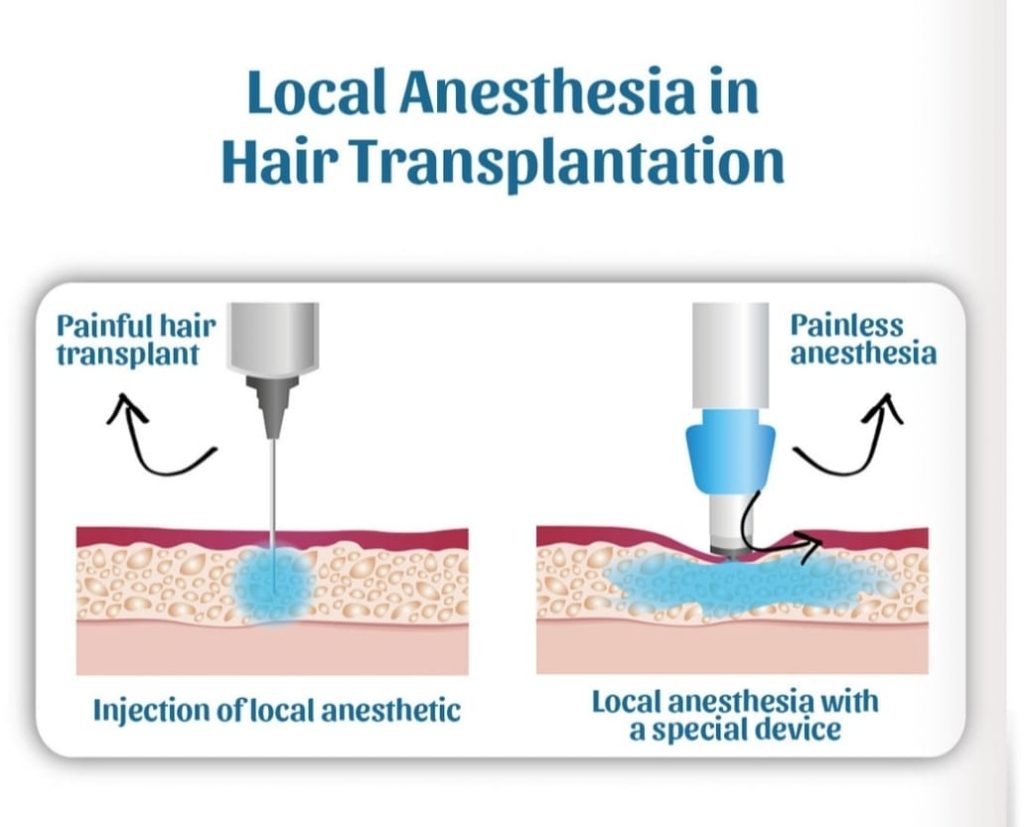 What is Painless Local Anesthesia? – Hair Voyage Turkey