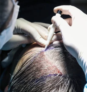 Unshaven Hair Transplant